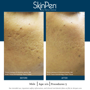 SkinPen - Before and After