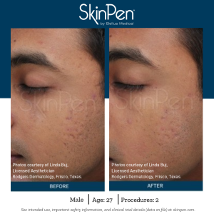 SkinPen - Before and After2